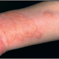 Đề phòng chứng mề đay do giá rét