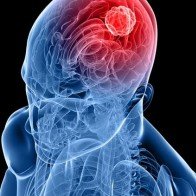 Kết hợp thuốc có thể giúp điều trị ung thư não