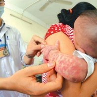 Việc cần làm khi trẻ sốt phát ban
