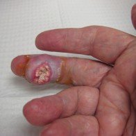 Bệnh gút có gây biến chứng không?