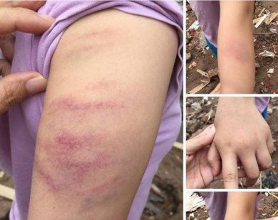 Học sinh bị giáo viên đánh bầm tím tay vì làm thiếu bài tập
