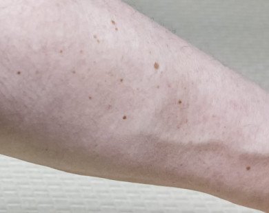 Nốt ruồi trên cánh tay tỉ lệ thuận với nguy cơ ung thư da