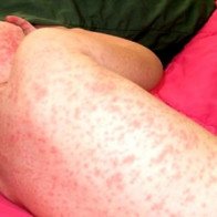 Dấu hiệu nhận biết sớm sốt xuất huyết