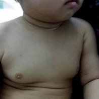 Bé gái 2 tuổi ngực to như 18 tuổi vì "ăn thuốc tránh thai" của mẹ