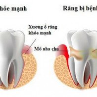 Bài thuốc trị nha chu viêm