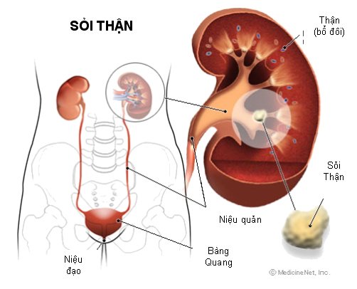 Những lý do nghiêm trọng khiến người Việt rất dễ mắc sỏi thận?