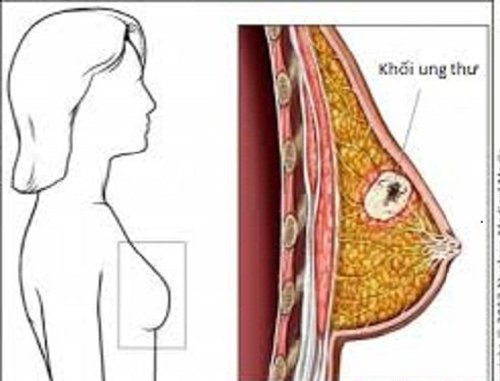 Dấu hiệu và cách phát hiện sớm nhất bệnh ung thư vú