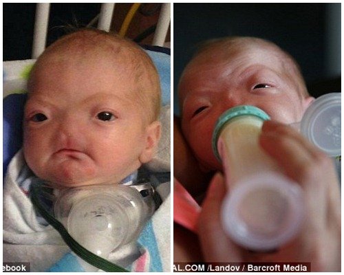 Mỹ: Kỳ lạ em bé sinh ra không có mũi