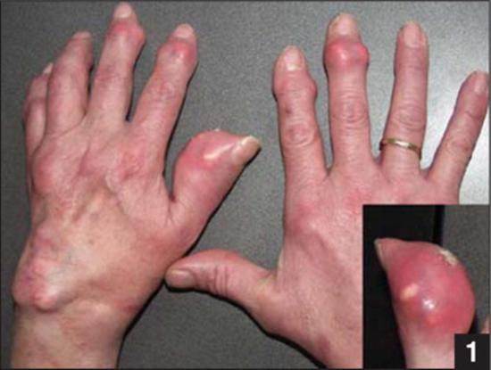 Nguyên do nào dẫn tới bệnh gút gia tăng chóng mặt tại Việt Nam?