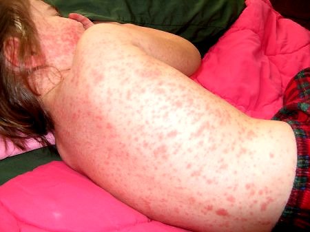 Những điều phải biết về bệnh sốt xuất huyết trước khi quá muộn