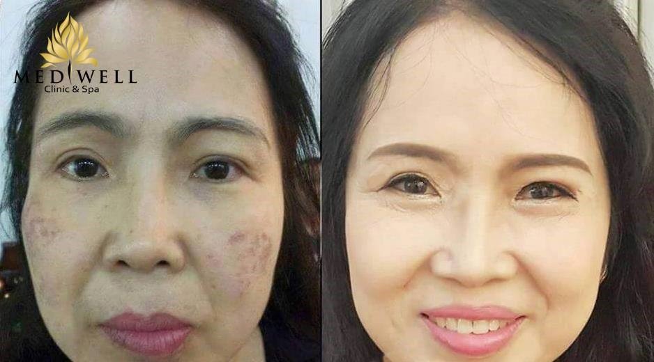 Lời khuyên của chuyên gia khi trị nám bằng Laser