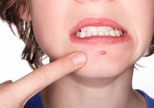 Tập hợp những "chiêu thức" trị mụn kỳ cục nhất quả đất