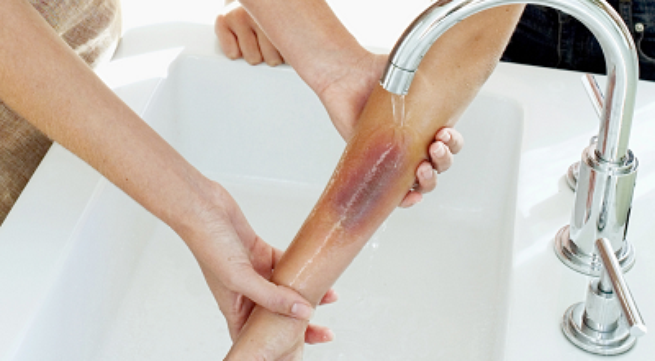 Cách xử trí khi bị bỏng lửa, dầu ăn và nước sôi