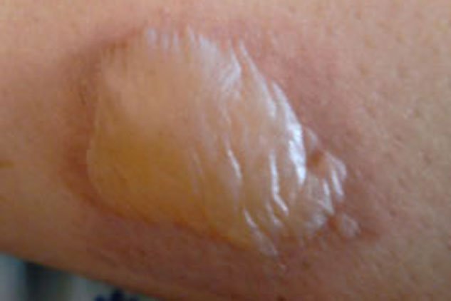 Cách xử trí khi bị bỏng lửa, dầu ăn và nước sôi