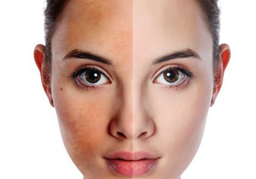 2 bước giúp cải thiện làn da không đều màu
