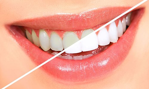 Lấy hết cao răng tại nhà mà không gây đau đớn