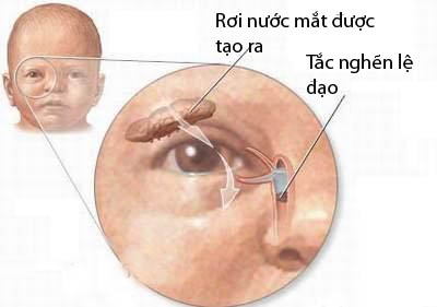 Nhỏ sữa mẹ vào mắt trẻ sơ sinh để chữa bệnh: Mẹ có thể gây mù lòa cho trẻ cả đời