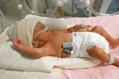 Bé 2 tháng tuổi bị viêm ruột hoại tử vì bố mẹ pha sữa quá đặc