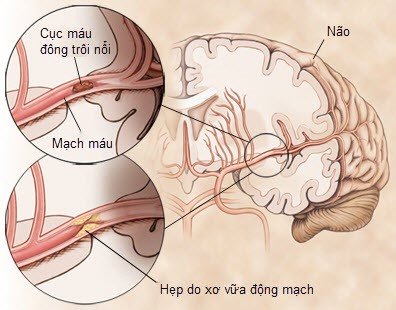 Thiếu máu não cục bộ