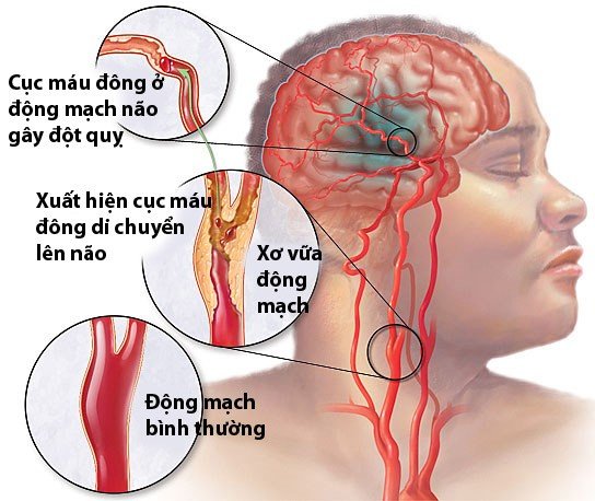 Thiếu máu não cục bộ