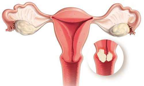 Bác sĩ cảnh báo 3 bệnh ung thư đường sinh dục ở phụ nữ