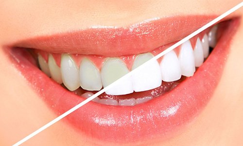 Mẹo giúp răng sáng bóng sau 2 phút cho những người sợ đi nha sĩ