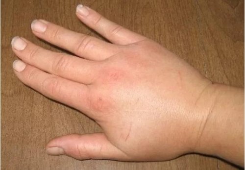 Nhận biết dấu hiệu bệnh ung thư qua bàn tay