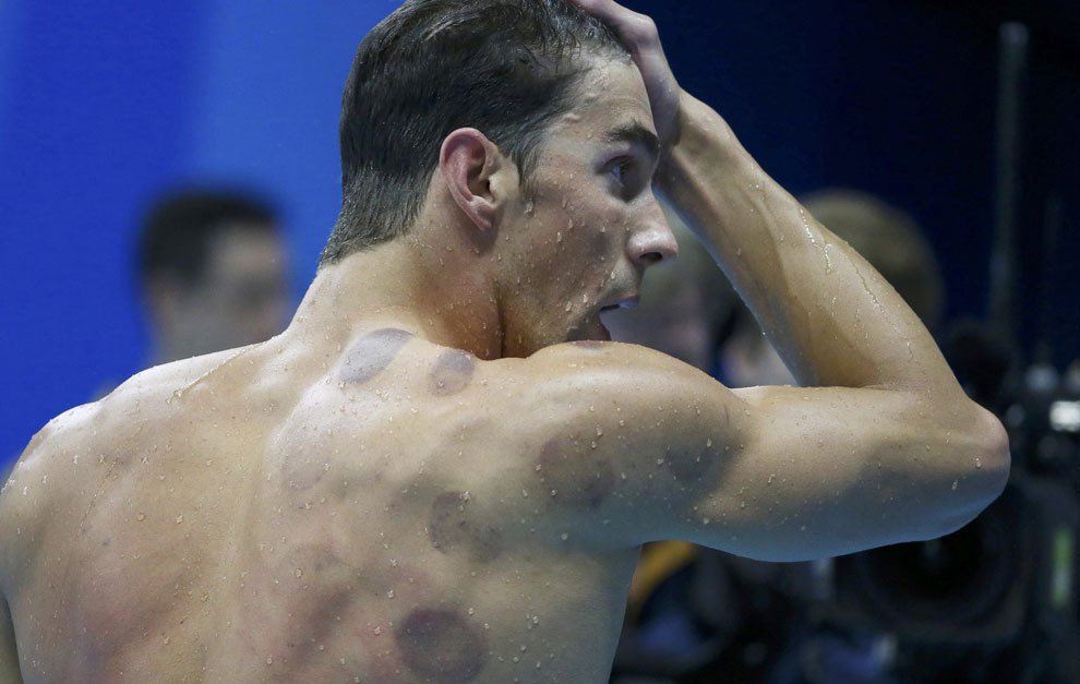 Michael Phelps giành HCV nhờ phương pháp cổ đại của Trung Quốc