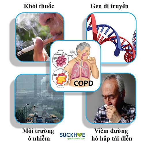 Những thông tin về bệnh tắc nghẽn phổi mạn tính