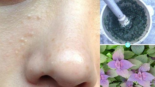 Da trắng căng mướt, sạch mụn sần nhờ 10 lá tía tô