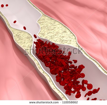 Phòng tránh và điều trị rối loạn lipid máu