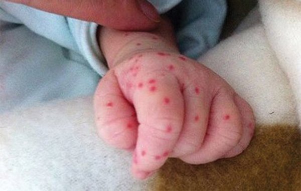 Sốt ở trẻ em và một số nguyên nhân thường gặp